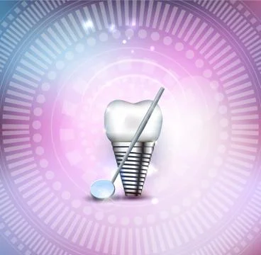 Tooth implant Illustrazione stock