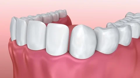 Tooth implant installation process, Medically accurate 3d animation Stock Footage 71362221