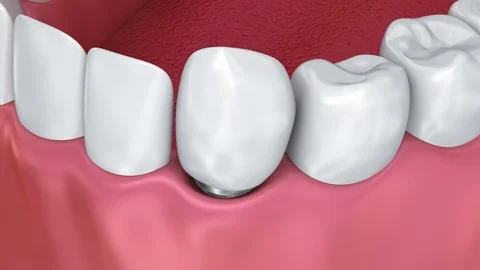 Tooth implant installation process, Medically accurate 3d animation Stock Footage 74246198