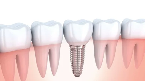 Tooth implantation 3d Stock Footage 79878637