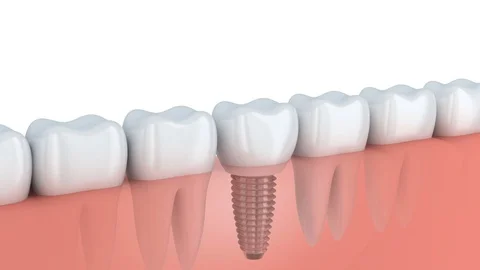 Tooth implantation Stock Footage 75339977
