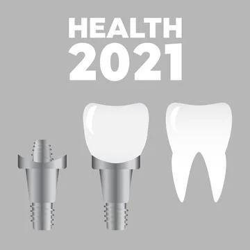 Tooth implants and normal teeth. Dental bone implantation. Anatomical tooth v Illustrazione stock