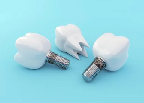 Tooth Implants and Tooth Crown on blue background, artificial teeth Stock Illustration