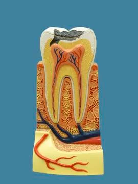 Tooth model with caries Stock Photos