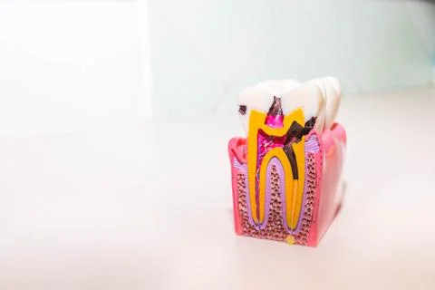 Tooth model with caries, tooth decay in dentist's office. Healthy teeth concept Stock Photos