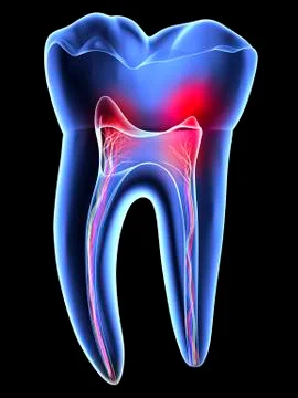 Tooth pain, toothache Stock Illustration