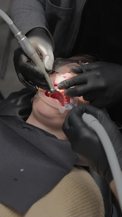 Tooth preparation for crowns using high-speed dental handpiece. Prosthetic Stock-Footage 341704885