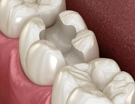 Tooth preparation for inlay placement. Medically accurate 3D illustration of Stock Illustration