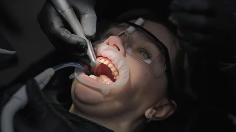 Tooth preparation process for dental crowns with enamel reduction and shaping 库存影片 339274279