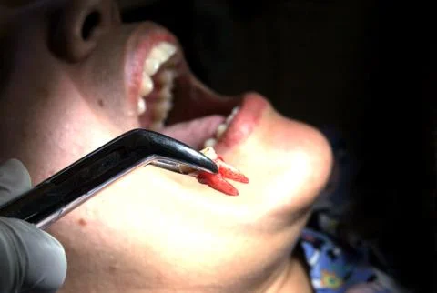 Tooth pulling Stock Photos