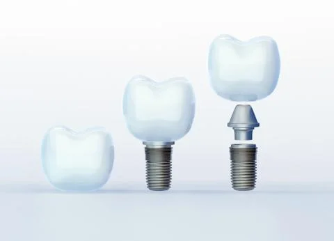 Tooth ?rown and Tooth Implants on white background, artificial tooth Stock-Illustration
