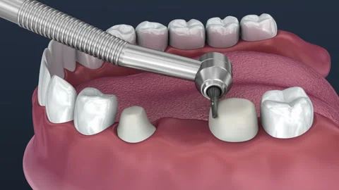 Tooth supported fixed bridge of 3 teeth. Medically accurate 3D Animation. Stock Footage 89582354