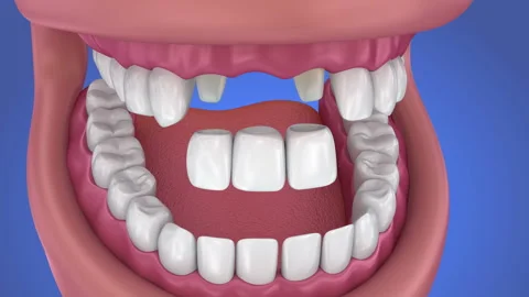 Tooth supported fixed bridge. Medically accurate 3d animation Stock Footage 89565782