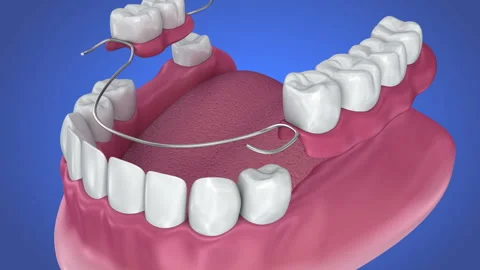 Tooth supported fixed bridge. Medically accurate. 3d animation Stock Footage 89565818
