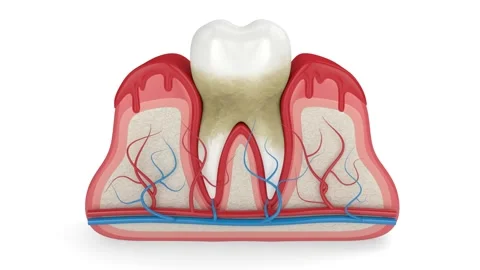 Tooth with tartar and  bleeding gums Stock Footage 146254057