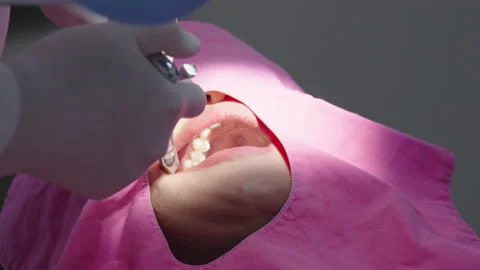 Tooth in a treatment 스톡 동영상 166963352