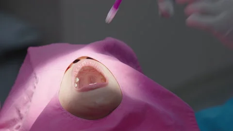 Tooth in a treatment 스톡 동영상 166963929