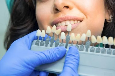Tooth whitening chart. Stock Photos