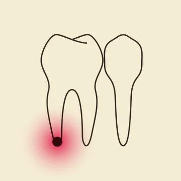 Toothache - Pulpitis Stock Illustration