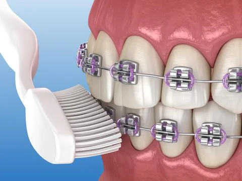 Toothbrush cleaning braces process. Medically accurate 3D illustration Illustrazione stock