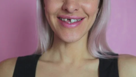 Toothless girl puts micro prosthesis. Tooth implantation. Stock Footage 99282477