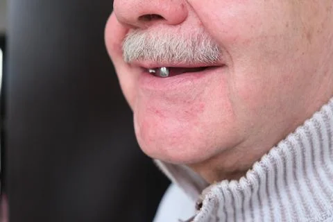 A toothless smile on an elderly man. preparation for prosthetics	 Stock Photos