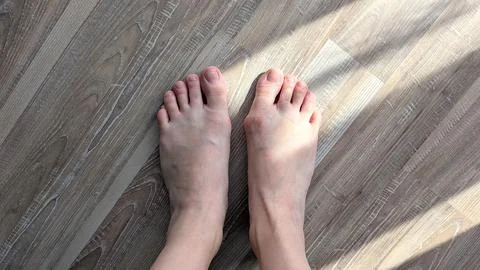 Top Down View of Bare Human Feet on Wooden Floor Showing Hallux Valgus Buni.. Stock Photos