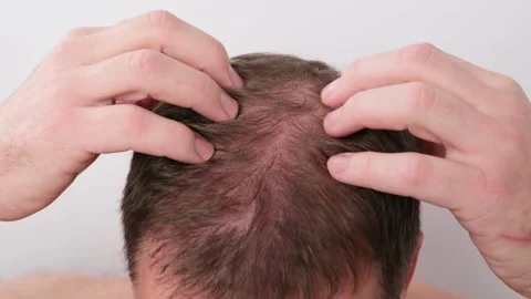 Top-down view of a concerned man examining his thinning hair and massaging his Video stock 337723320