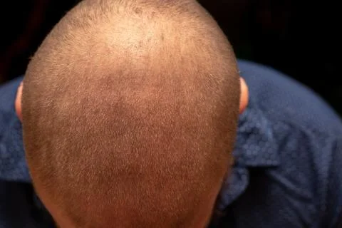 Top down view of a man's bald head, receeded hairline. Isolated on black back Stock Photos