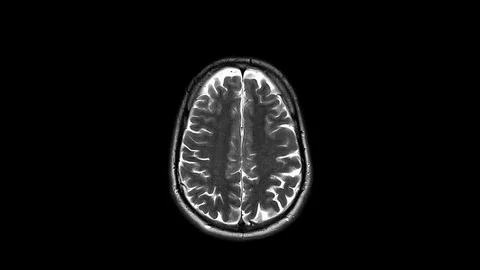 Top MRI Brain Scan Ax PD with high luminosity Stock Footage 104441133