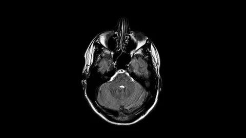 Top MRI Brian Scan Ax Flair Stock Footage 104441092