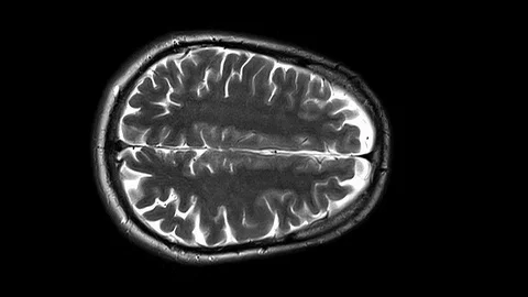 Top Side MRI Brain Scan Ax PD Stock Footage 104511343