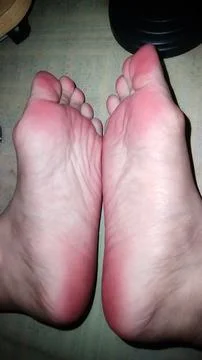 Top view of human bare feet soles with redness on heels and toes Stock Photos