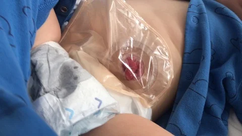 Top view on transparent colostomy pouch attached to baby patient. Stock Footage 116229680