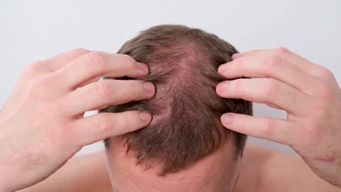 Top view of young man examining his scalp, concerned about hair thinning and Video stock 337723330