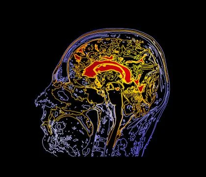 Topographic map MRI of the human brain. Stock Illustration