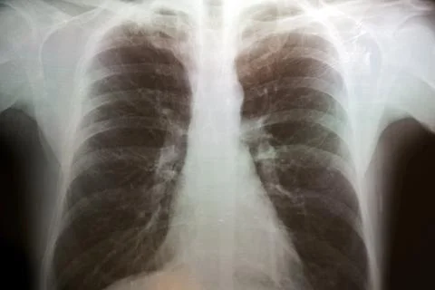 Torax X-Ray Stock Photos
