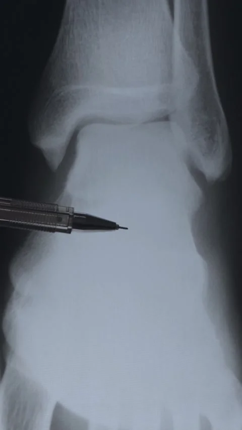 Torn ankle Vídeo Stock 321303039