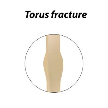 Torus fracture Bone. Infographics. Vector illustration on a lined background. Stock Illustration
