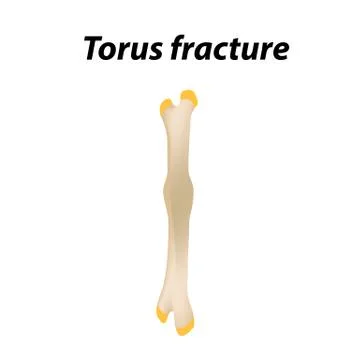Torus fracture Bone. Infographics. Vector illustration on a lined background. Stock Illustration