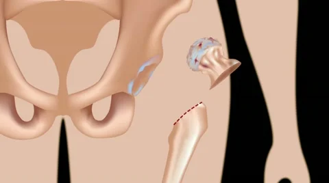 Total hip replacement surgery Stock Footage 10852123