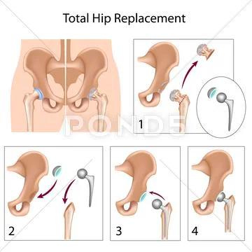 Total hip replacement surgery Stock Illustration