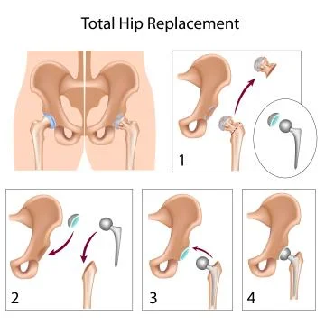 Total hip replacement surgery Stock Illustration