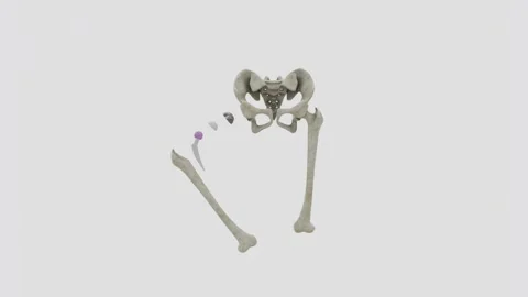 Total hip replacement is a surgical procedure that replaces damaged or diseased Stock Footage 343908931