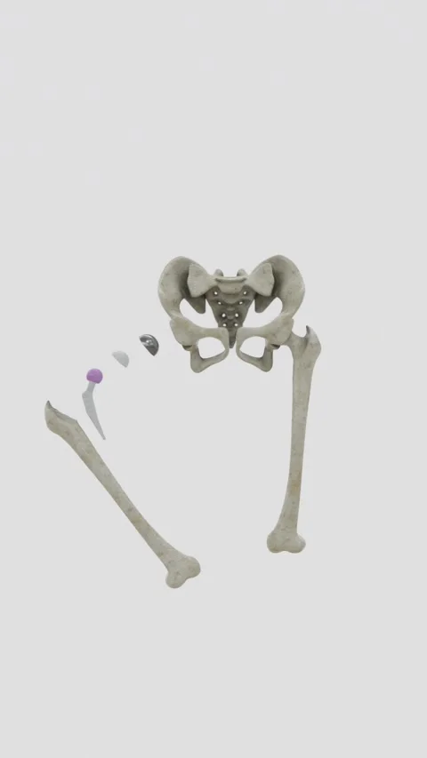 Total hip replacement is a surgical procedure that replaces damaged or diseased Stock Footage 343908945