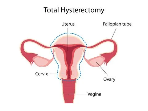 Total hysterectomy Stock Illustration