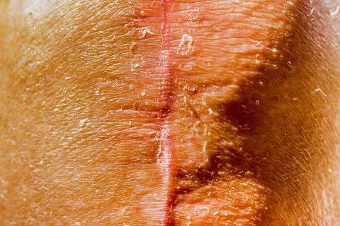 Total knee implants legs Stock Photos