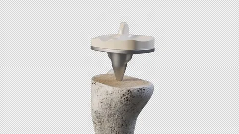 Total Knee Replacement Stock-Footage 241689073