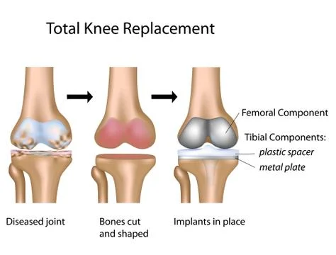 Total knee replacement surgery 스톡 일러스트