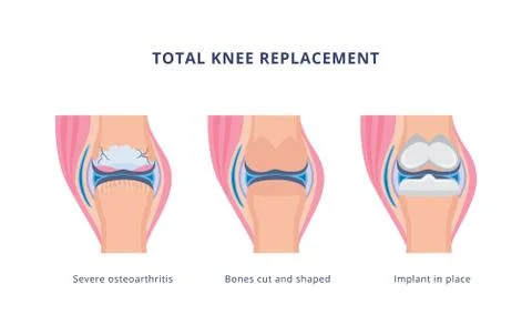 Total knee replacement surgery procedure, flat vector illustration isolated. 스톡 일러스트